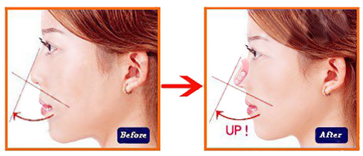 Perfect Nose Clip - Για βελτίωση του σχήματος της μύτης