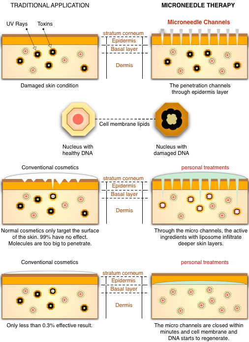 Micro NeedleRoller - Επαγγελματική μέθοδος Ανανέωσης,Αντιγήρανσης, βελτίωσης της επιδερμίδας derma roller needle roller botox facelift dermaroller